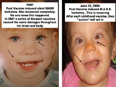 vaccine-damage-ischemia