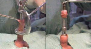 Circumcision-Procedure-300x164