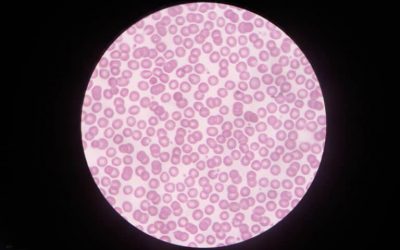 Doctor Reveals the Corona Effect – Claims COVID is Blood Coagulation