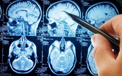 Autistic, Alzheimer’s & Multiple Sclerosis Brain Tissues Have Significant Amounts of Aluminum In Them