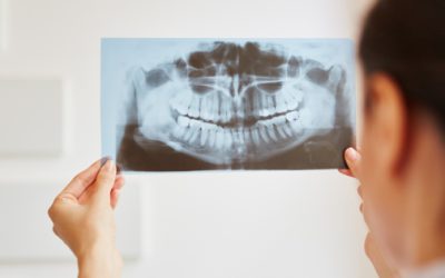 Is It Wise to Get Your Wisdom Teeth Pulled?